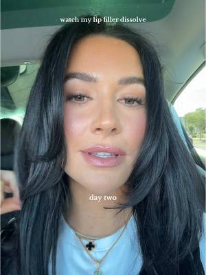 A post by @averyywoods on TikTok caption: I don’t even recognize myself 🫣 I got lip filler at 21 to help even out my lips because of a dog bite scar- going more natural at 30 🤌🏼 #f#fypv#virall#lipfillerm#momm#momsoftiktokm#momlifem#motherhoodr#relatablel#lifestyleb#beautym#momsover30
