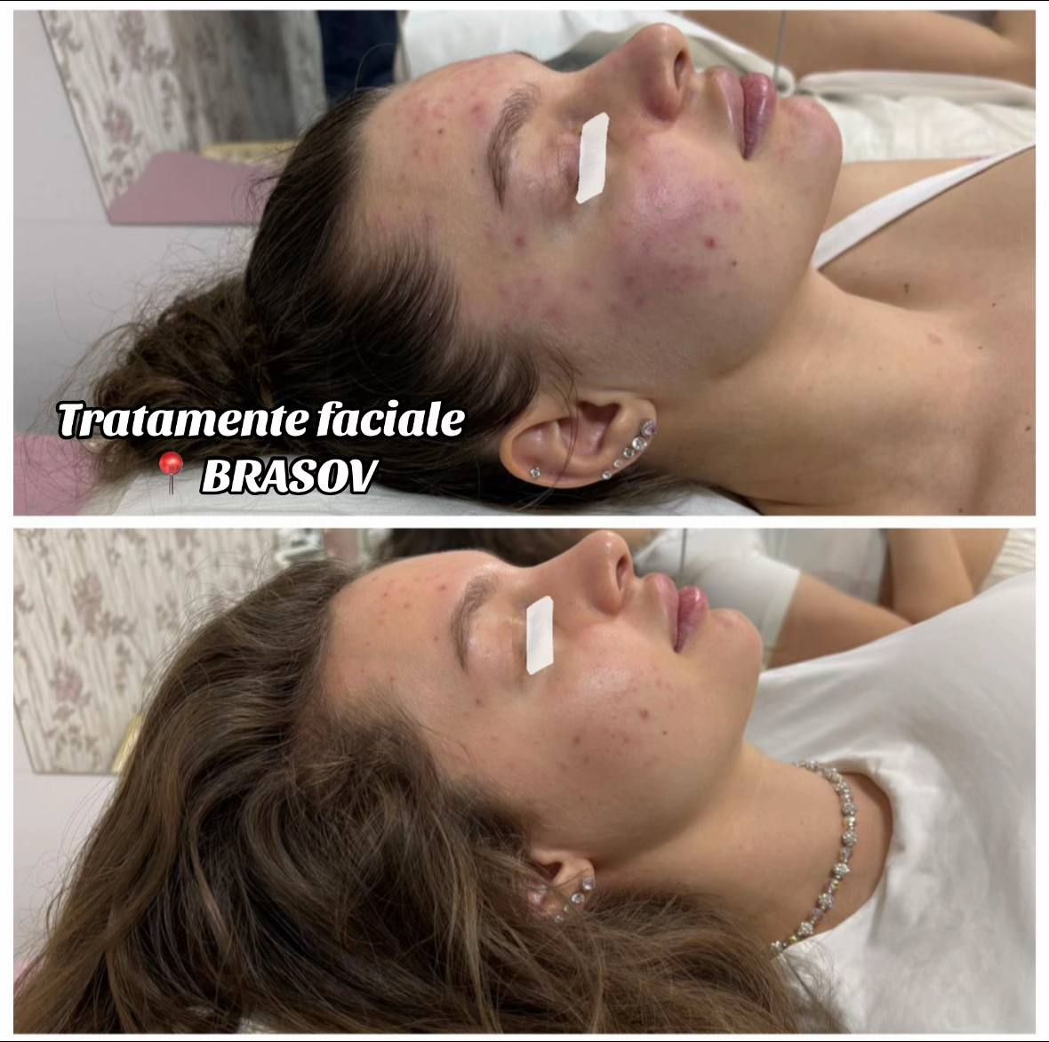 A post by @mirunamilu1 on TikTok caption: #foryou #viral #tratamentefaciale #brasov #mezoterapievirtuala #oxigenhiperbaric #microdermabraziune #beforeandafter 