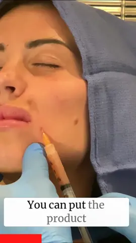 A post by @rajanimdskincare on TikTok caption: GET RID OF LAUGH LINES WITH BOOSTERS #fillers #sculptra #rajanimdskincare 