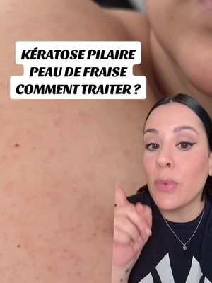 A post by @frenchtouchofmakeup on TikTok caption: Kératose pilaire 2 étapes pour l’atténuer*publicite @First Aid Beauty 🍑KP gommage corps AHA 10% avec la lotion KP lissante et hydratante AHA 10% et urée  NEW la senteur pêche 🍑🍑🍑dispo chez @SEPHORA  #SkinCare #bodycare #firstaidbeauty 