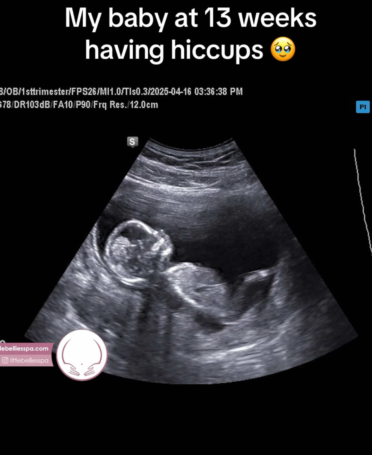 A post by @arianalee99 on TikTok caption: I didn’t know they could hiccup this early 🥹🩷 #ultrasound #baby #13weekspregnant #13weeks 