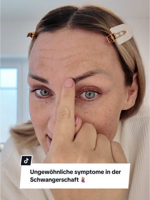 A post by @aliciasmumlife on TikTok caption: Anzeige I Diese Schwangerschaft hat nochmal ganze andere Symptome mit sich gebracht als die beiden davor. Das Ungewöhnlichste sind wohl die Pigmentflecken auf meiner Stirn. 🙃 Ich habe zum Glück die Liftactiv B3 Pigment Specialist Routine für mich entdeckt und nutze sie schon seit 12 Wochen. Mit dem passenden Serum, Tages- und Nachtcreme und der dazugehörigen Augencreme konnte ich richtig tolle Ergebnisse erzielen.  Also nicht jedes Schwangerschaft-Symptom muss man einfach so über sich ergehen lassen. ☺️ @Vichy Laboratoires #Vichy #MEvsDARKSPOTS #VichySkincare #SkinCare