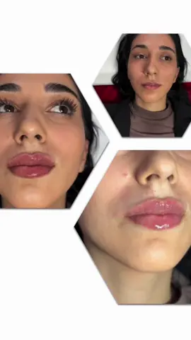 A post by @beautyelixiraf on TikTok caption: ##RusianLipss ##RusianLipss ##hyaluronpen #hyaluronpen #hyaluronpen Lips##lips ##lips ##Craiova #Craiova #Craiova  #foryooupage #foryooupage #lips 