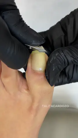 A post by @talitacardozo on TikTok caption: Transformação Pedicure. Separador de dedos da minha marca, pode ser esterilizado em autoclave e estufa.  loja.talitacardozo.com.br