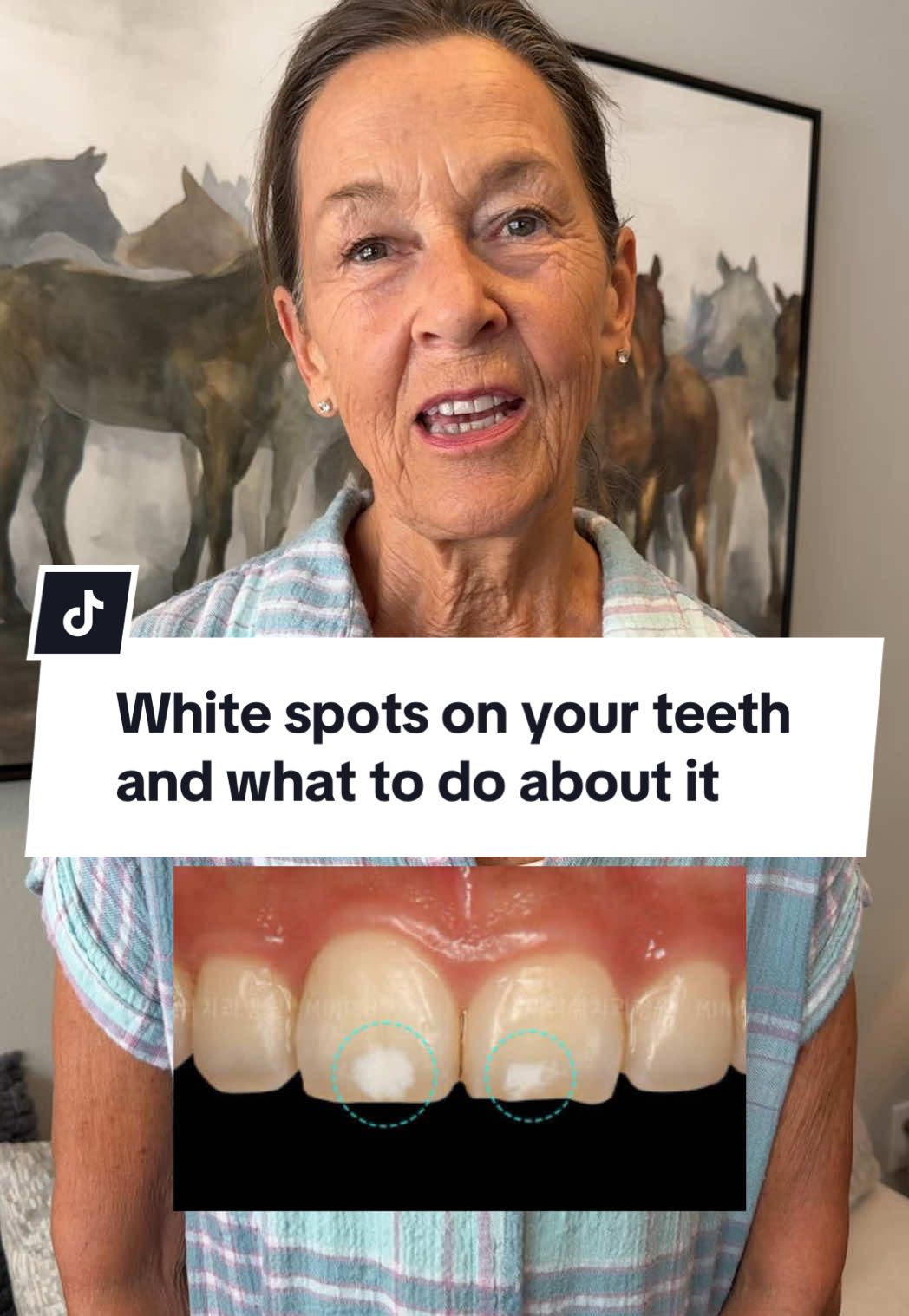 A post by @drelliephillips on TikTok caption: White spots on your teeth and what to do about it #teethtok #toothtok #teethhacks #teethcare #teethhealth 