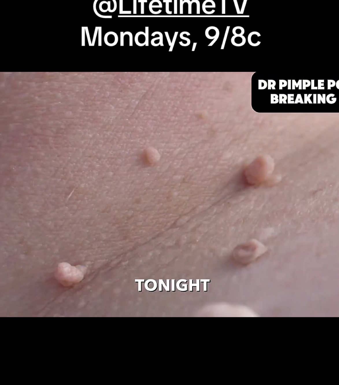 A post by @drpimplepopper on TikTok caption: NEW episode tonight on @LifetimeTV ! #drpimplepopper #breakingout 