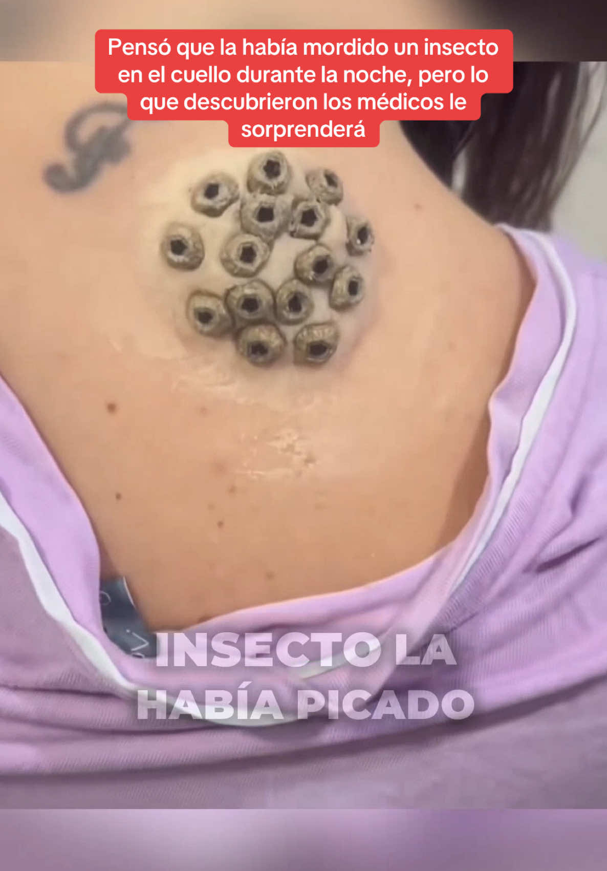 A post by @historia_real_estr on TikTok caption: Pensó que la había mordido un insecto en el cuello durante la noche, pero lo que descubrieron los médicos le sorprenderá. #historiasimpactantes #sorprendente #Sorpresa #misterio 
