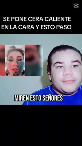 A post by @angelfv19 on TikTok caption: Sepuso cera caliente y le paso esto 😱