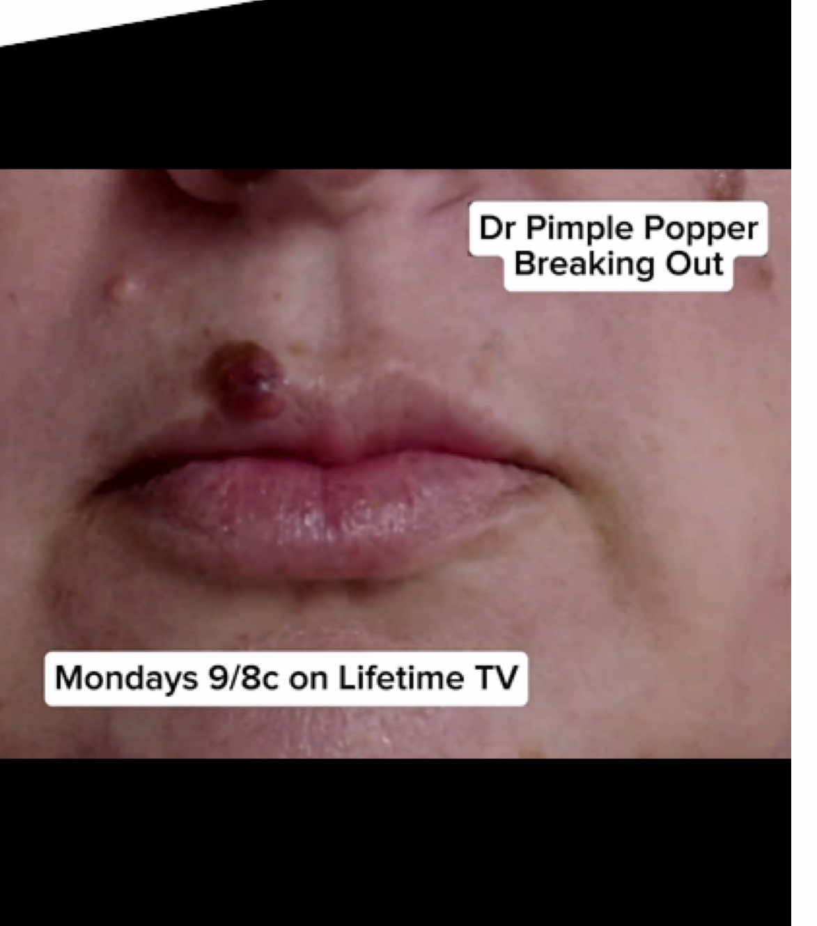 A post by @drpimplepopper on TikTok caption: Watch a NEW episode TONIGHT @LifetimeTV  Mondays 9/8c #drpimplepopper #breakingout 