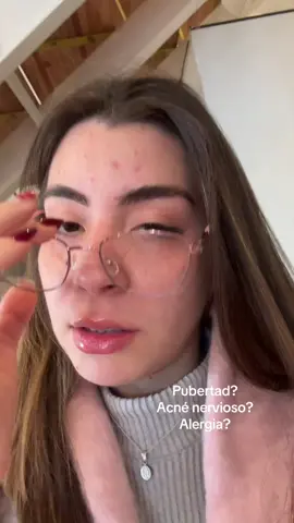 A post by @nahii_caceres on TikTok caption: Ya tome rocutan me dieron el alta, meses después mi piel se ve así. Alguna explicación?