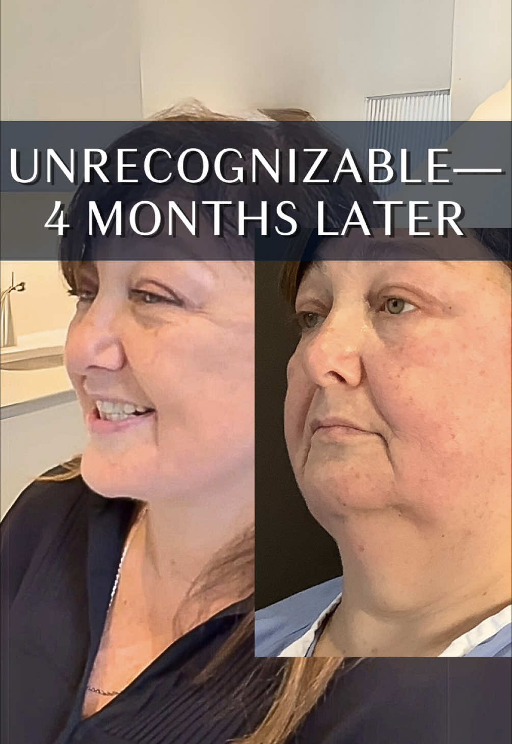 A post by @albertplasticsurgery on TikTok caption: Another week, yet another THRILLED patient 👏🏼 This lovely patient was 4 months post-op her face and neck lift combination procedure done completely under local anesthesia! And of course, absolutely 0 visible scars, especially this far out. She is well out of the healing stage and now fully reaping all the benefits of her facelift & neck lift— and we’re just as happy and she is 💙 Ready to turn back time on your face? Consult with us for free today! 📞 (212)-203-8623 💻 www.albertplasticsurgery.com 📍 950 Park Avenue, New York, NY  #necklift #facelift #smasfacelift  #deepplanefacelift #rhytidectomy  #PlasticSurgery #plasticsurgeon #AntiAging #antiwrinkle #beauty #aesthetics #lift #NYC #nycplasticsurgery #parkavenue #transformation #nycplasticsurgeon #nycplasticsurgery #testimonial #beforeandafter #MaestriDelPov #pointofview #fyp #foryou #foryoupage 