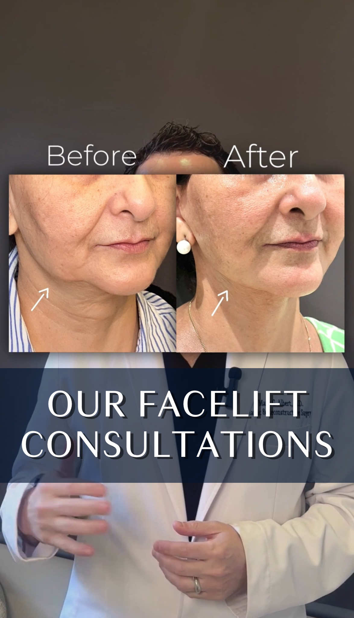 A post by @albertplasticsurgery on TikTok caption: Facelifts aren’t look cookie-cutter— they’re all about personal priorities 👇🏻 For most patients, it’s the jowls — that lower face heaviness that softens the jawline. Others are looking for a real lift through the cheeks. With techniques like SMAS and deep-plane facelifts, we’re able to do both— lifting where it counts and restoring structure without looking overdone 🪄 Ready to turn back time on your face? Consult with us for free today! 📞 (212)-203-8623 💻 www.albertplasticsurgery.com 📍 950 Park Avenue, New York, NY  #horizontalfacelift #verticalfacelift #facelift #minilift #weekendlift#minifacelift #rhytidectomy #deepplanefacelift #smas #PlasticSurgery #plasticsurgeon #MaestriDelPov #AntiAging #antiwrinkle #beauty #aesthetics #cosmetics #collagen #lift #NYC #nycplasticsurgery #transformation #beforeandafter #fyp #foryou #foryoupage 