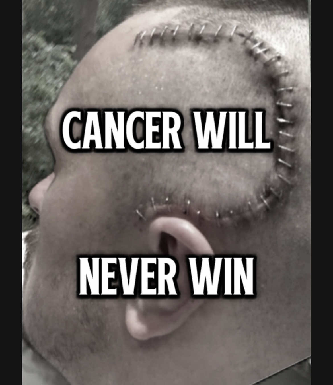 A post by @thekingofchemo on TikTok caption: I want to be the first ☝🏻🥇 person ever to raise money for charity without donations.  Over 💰525,000💰raised for charity since I started, so the system works.  Breaking a meaningful world record is very cool, but someone will eventually break it again. However if I break that world record by getting you to follow the account instead of donating, and get companies to donate to charity in exchange for advertising on a platform that you have helped to build. That makes me the first person EVER to do that. And first is eternal. I bet many of you can name the first men to climb Everest, land on the moon, or run the first 4min mile, but who honestly knows the other people who’ve done those things? Comment if you can name all 4 of the firsts 🗻🌔🚀🏃🏻💨⏱️ I don’t want to be the best. I want to be the first. #cancerwarrior #motivational #inspire #inspirational #focus #masteryourmind #manifestyourdreams #manifestyourdestiny #manifestyourlife #relentless #unbreakable #believeinyouself #findyourpurpose #purpose #terminalcancer #braincancer  #worldrecord #charity #chemo #cancerkiller #nevergiveup #findyourself 