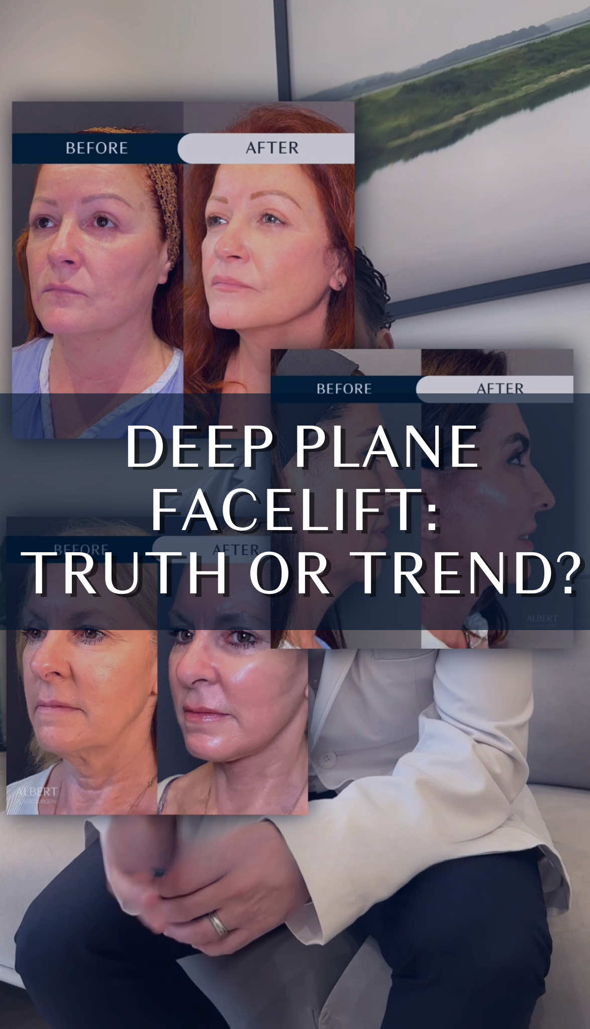 A post by @albertplasticsurgery on TikTok caption: “Deep plane facelift” “SMAS facelift”— we know you’ve been hearing it all over social media lately, but does it really matter? 👀 There’s a lot of buzz around which technique is “best.” But here’s the truth: there’s no one-size-fits-all solution when it comes to facial rejuvenation The most important factor is not the trend— it’s YOU. Your anatomy, age, skin elasticity, and goals all play a critical role in selecting the right surgical approach Whether it’s a deep plane facelift or another method, the key is to stay open-minded and let the consultation guide the way. A skilled facial plastic surgeon will always tailor the plan to your unique structure for results that are natural, long-lasting, and truly transformative. Which is exactly what we do here at APS! 🪄 Ready to turn back time on your face? Consult with us for free today! 📞 (212)-203-8623 💻 www.albertplasticsurgery.com 📍 950 Park Avenue, New York, NY  #deepplanefacelift #horizontalfacelift #verticalfacelift #facelift #minilift #weekendlift #minifacelift #rhytidectomy #deepplanefacelift #smas #PlasticSurgery #plasticsurgeon #MaestriDelPov #AntiAging #antiwrinkle #krisjenner #kyliejenner #kimkardashian #beauty #aesthetics #collagen #lift #NYC #nycplasticsurgery #newyork #fyp #foryoupage #foryou 