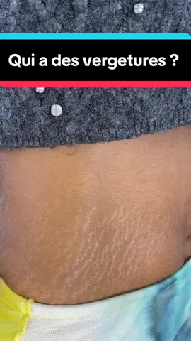 A post by @dialuskinfr on TikTok caption: Qui a des vergetures? 💯 #fypppppppppppppppppppppppp #problem #glowupchallenge #stretchmarks #vergetures #bodycare #fyp #stretchmark 
