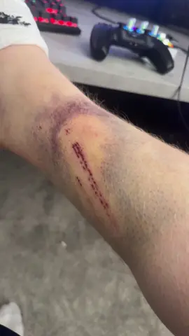 A post by @angryginge13 on TikTok caption: DAY 3 UPDATE! It’s gettin worse 🤯