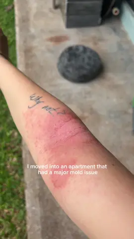 A post by @bearenger on TikTok caption: 5 things I'm doing to help recover from MOLD TOXICITY naturally…  Healing from mold toxicity has been one of the scariest and most freeing experiences of my life. It can feel isolating, but I've learned that so many people are going through this quietly. Here's what's been helping me the most on my healing journey:⁠ ⁠ 1. Nervous system regulation – Your body can't detox when it's in fight or flight. I've been prioritizing nervous system support through rest, grounding, and slow, mindful movement to help my body feel safe enough to heal. 2. Detoxing with saunas + hot pilates – Sweating is one of the most effective ways to support detox. Infrared sauna sessions and hot pilates help move toxins through my lymphatic system while building strength and resilience. 3. Whole foods that nourish + detox – I've focused on eating clean, supportive meals that fuel my body and support my liver, gut, and energy levels—foods that work with my body, not against it. 4. Whole food-based supplements – I'm using supplements like herbs, minerals, and superfoods—that support detox pathways, bind to toxins, and replenish what mold has depleted. 5. Getting tested with MoldCo – This gave me real clarity. I had symptoms for months without answers. MoldCo helped me pinpoint the root cause through functional testing and gave me a clear, supportive plan for healing. It was a turning point in my journey. This journey is challenging, but it's also empowering. You're definitely not alone! ❤️‍🩹 #gifted #MoldToxicity #NaturalHealing #MoldRecovery #NervousSystemSupport #DetoxJourney #HealingFromWithin #Wellness #HealthyTips 