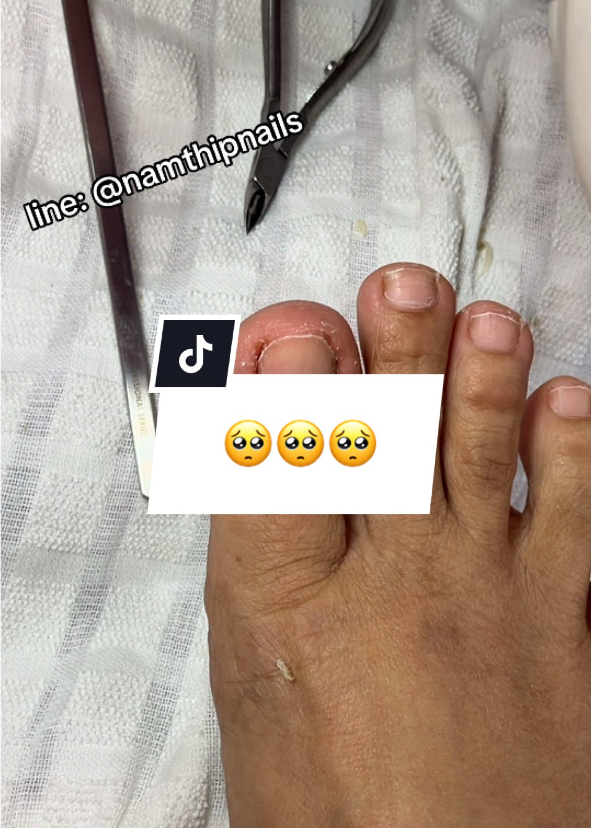 A post by @namthipnails5 on TikTok caption: 💓 #namthipnails #ตัดเล็บขบ #ตัดหนัง #ทำเล็บ #ร้านตัดเล็บขบ #ร้านตัดเล็บขบราม2 #ตัดเล็บ #เล็บขบ  #เล็บเชื้อรา Fb : namthipnails  Line : @namthipnails  นัมเบอร์วัน8 ตลาดม.ราม2  กทม  Map: namthipnails  https://goo.gl/maps/JmwpCKLfKwmhKGK96  ร้านเปิดทุกวัน เวลา12.00น-22.00น.