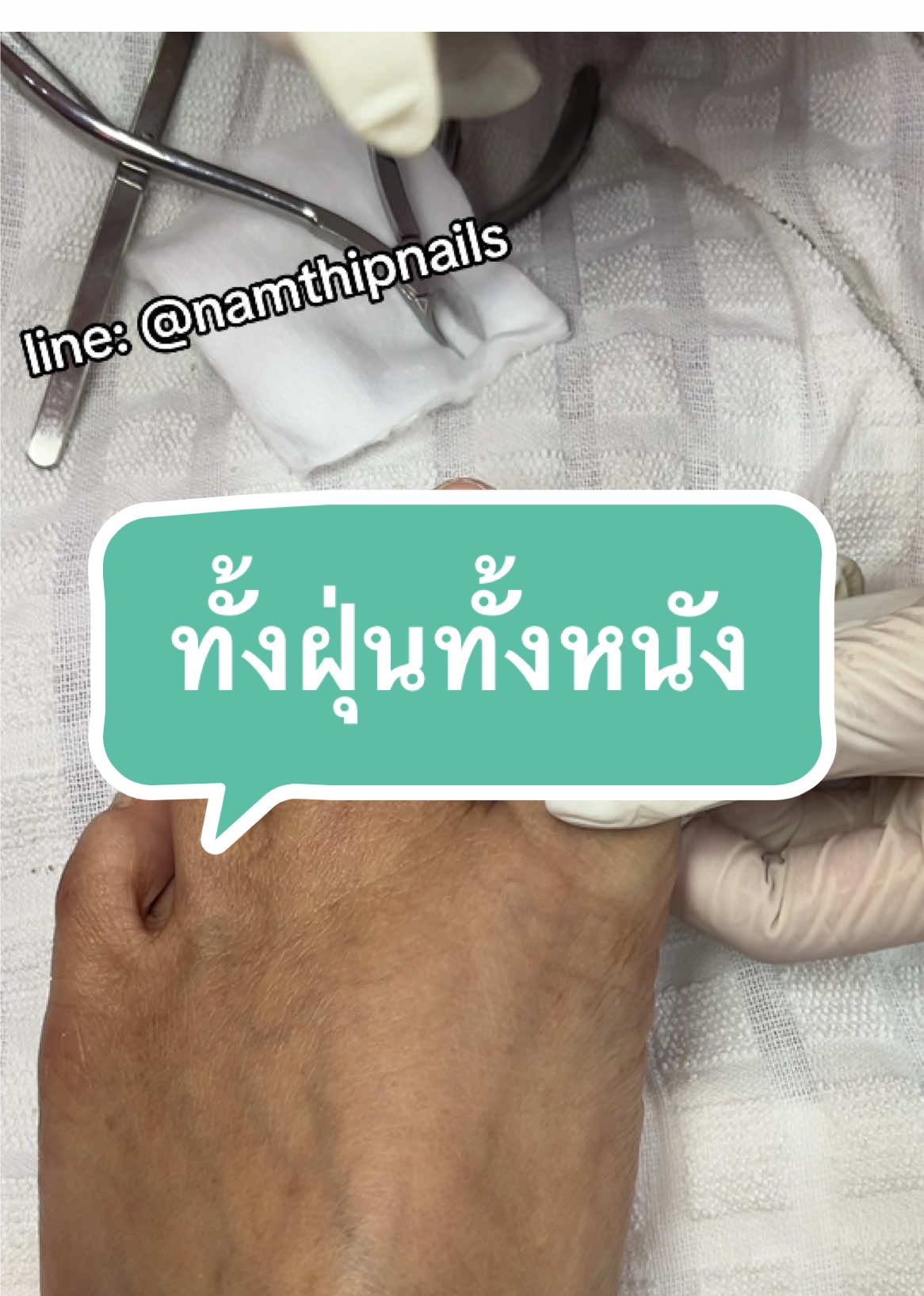 A post by @namthipnails5 on TikTok caption: 💓 #namthipnails #ตัดเล็บขบ #ตัดหนัง #ทำเล็บ #ร้านตัดเล็บขบ #ร้านตัดเล็บขบราม2 #ตัดเล็บ #เล็บขบ  #เล็บเชื้อรา Fb : namthipnails  Line : @namthipnails  นัมเบอร์วัน8 ตลาดม.ราม2  กทม  Map: namthipnails  https://goo.gl/maps/JmwpCKLfKwmhKGK96  ร้านเปิดทุกวัน เวลา12.00น-22.00น.