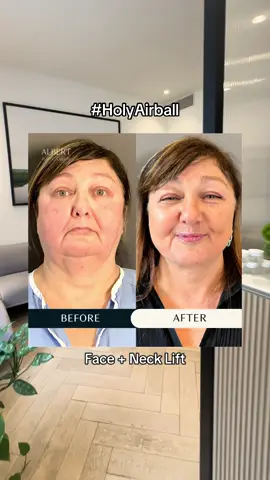A post by @albertplasticsurgery on TikTok caption: Over 70% of our patients come in for a 2+ combo procedure… that’s because it’s our specialty 🪄 It’s like ironing a shirt and leaving the sleeves… just like a facelift paired with a neck lift, works wonders on rejuvenating your appearance and delivering a naturally balanced, long-term solution.  Want to explore your effortlessly natural, time-reversing options? Consult with us today! 📞 (212)-203-8623 💻 www.albertplasticsurgery.com 📍 950 Park Avenue, New York, NY  #holyairball #co2 #co2laser #laser #facelift #smasfacelift #minilift #minifacelift #deepplanefacelift #rhytidectomy #PlasticSurgery #plasticsurgeon #MaestriDelPov #AntiAging #antiwrinkle #beauty #aesthetics #lift #NYC #nycplasticsurgery #transformation #beforeandafter #explorepage #explore #plasticsurgerytransformation #plasticsurgerybeforeandafter 