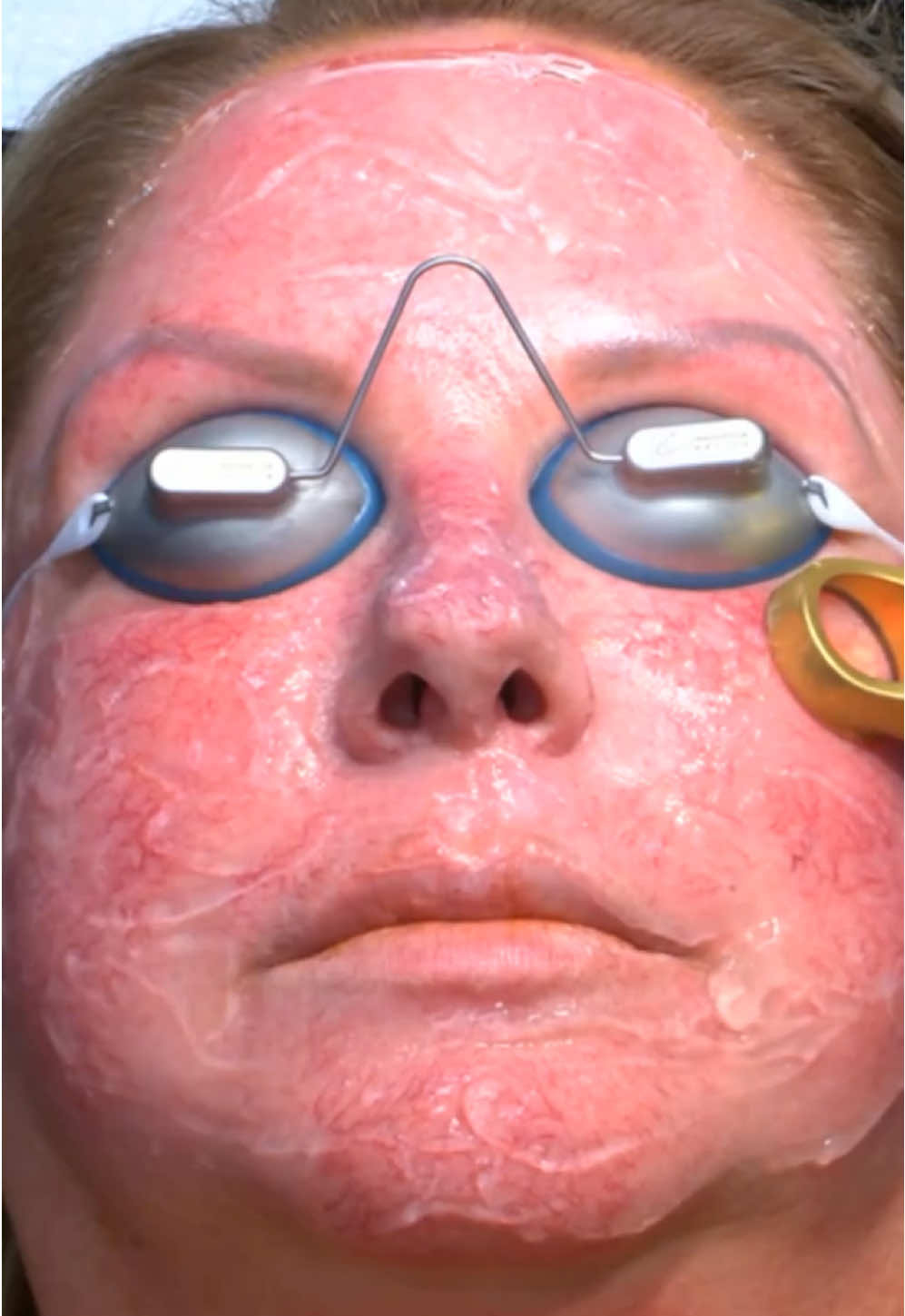 A post by @drpimplepopper on TikTok caption: Tonight is the hump! We are midway through the NEW season of Dr Pimple Popper Breaking Out on @LifetimeTV and there is a BRAND NEW episode on TONIGHT (Mondays) 9/8c! #drpimplepopper #breakingout