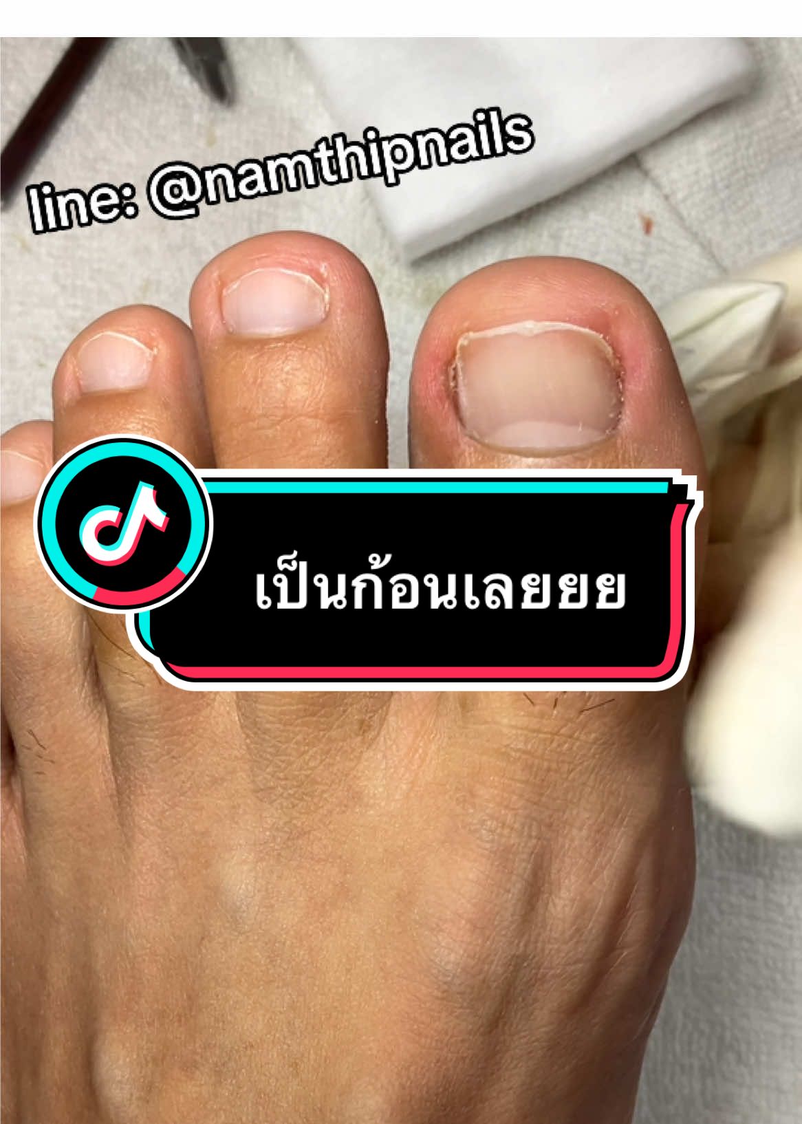 A post by @namthipnails5 on TikTok caption: 💓 #namthipnails #ตัดเล็บขบ #ตัดหนัง #ทำเล็บ #ร้านตัดเล็บขบ #ร้านตัดเล็บขบราม2 #ตัดเล็บ #เล็บขบ  #เล็บเชื้อรา Fb : namthipnails  Line : @namthipnails  นัมเบอร์วัน8 ตลาดม.ราม2  กทม  Map: namthipnails  https://goo.gl/maps/JmwpCKLfKwmhKGK96  ร้านเปิดทุกวัน เวลา12.00น-22.00น.