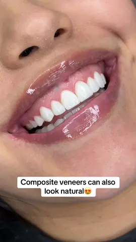 A post by @wondersmiledentalcenter on TikTok caption: ✨ Transform your smile in just one day! Get 20 composite veneers for only $2,500 USD 🦷💫 📍 Miami clinic 📲 Contact us: 561-668-5094 Limited spots available #veneersjourney #porcelainveneers #neworleansveneers #chicagoveneers #dentistry #veneerscolombia #bestdentalclinic #veneers #miamiveneers #hollywoodsmile #smiledesign #cosmeticdentist #cosmeticdentistry #dentaltourism #smiledentist #bestdentist #lifechanging #houstonveneers #exportingsmiles 