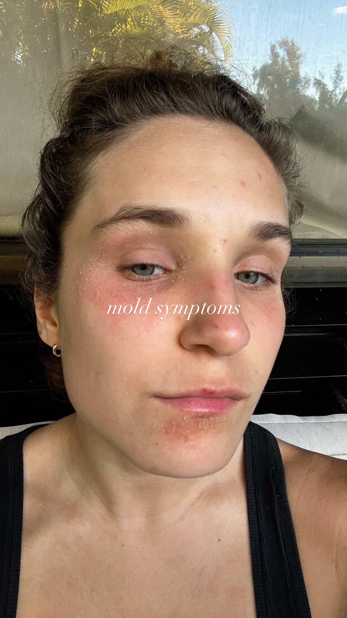 A post by @bearenger on TikTok caption: Some of the symptoms I experienced with mold, toxicity were itchy puffy eyes, sneezing, coughing, congestion, itchy throat, skin rashes, fatigue, hives, brain fog, sensitivity, and so much more. If you are going through this, you are not alone, get yourself checked, get your house checked. I tested with @themoldcompany and was able to better connect my symptoms to my mold toxicity. Sending so much love! #wellnesstips #wellness #moldtoxicity #moldawareness 