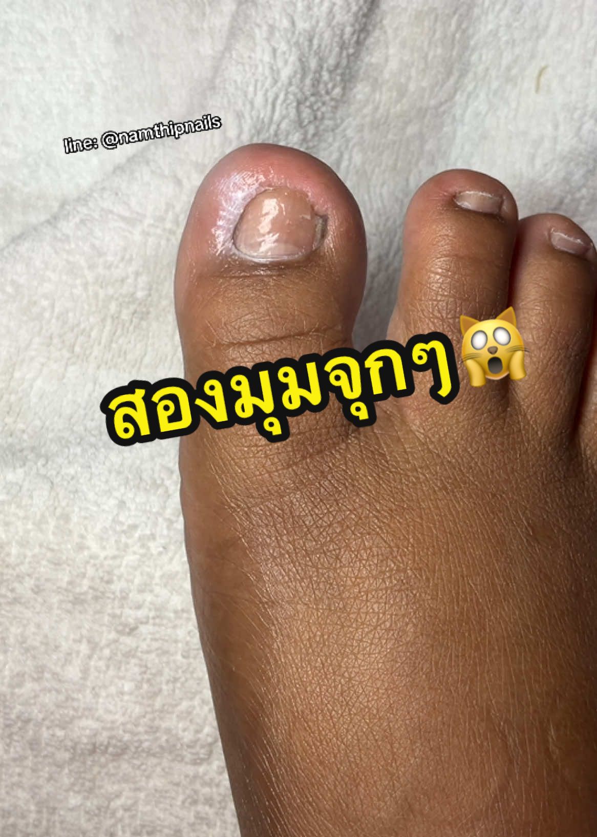 A post by @namthipnails5 on TikTok caption: 💓 #namthipnails #ตัดเล็บขบ #ตัดหนัง #ทำเล็บ #ร้านตัดเล็บขบ #ร้านตัดเล็บขบราม2 #ตัดเล็บ #เล็บขบ  #เล็บเชื้อรา Fb : namthipnails  Line : @namthipnails  นัมเบอร์วัน8 ตลาดม.ราม2  กทม  Map: namthipnails  https://goo.gl/maps/JmwpCKLfKwmhKGK96  ร้านเปิดทุกวัน เวลา12.00น-22.00น.