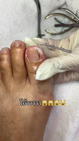 A post by @namthipnails5 on TikTok caption: 💓 #namthipnails #ตัดเล็บขบ #ตัดหนัง #ทำเล็บ #ร้านตัดเล็บขบ #ร้านตัดเล็บขบราม2 #ตัดเล็บ #เล็บขบ  #เล็บเชื้อรา Fb : namthipnails  Line : @namthipnails  นัมเบอร์วัน8 ตลาดม.ราม2  กทม  Map: namthipnails  https://goo.gl/maps/JmwpCKLfKwmhKGK96  ร้านเปิดทุกวัน เวลา12.00น-22.00น.