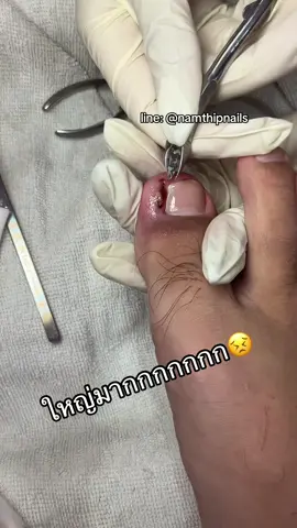 A post by @namthipnails5 on TikTok caption: 💓 #namthipnails #ตัดเล็บขบ #ตัดหนัง #ทำเล็บ#ทําเล็บดเล็บขบ ##ร้านตัดเล็บขบราม2##ตัดเล็บ##เล็บขบ ##เล็บเชื้อราFb : namthipnails  Line : @namthipnails  นัมเบอร์วัน8 ตลาดม.ราม2  กทม  Map: namthipnails  https://goo.gl/maps/JmwpCKLfKwmhKGK96  ร้านเปิดทุกวัน เวลา12.00น-22.00น.
