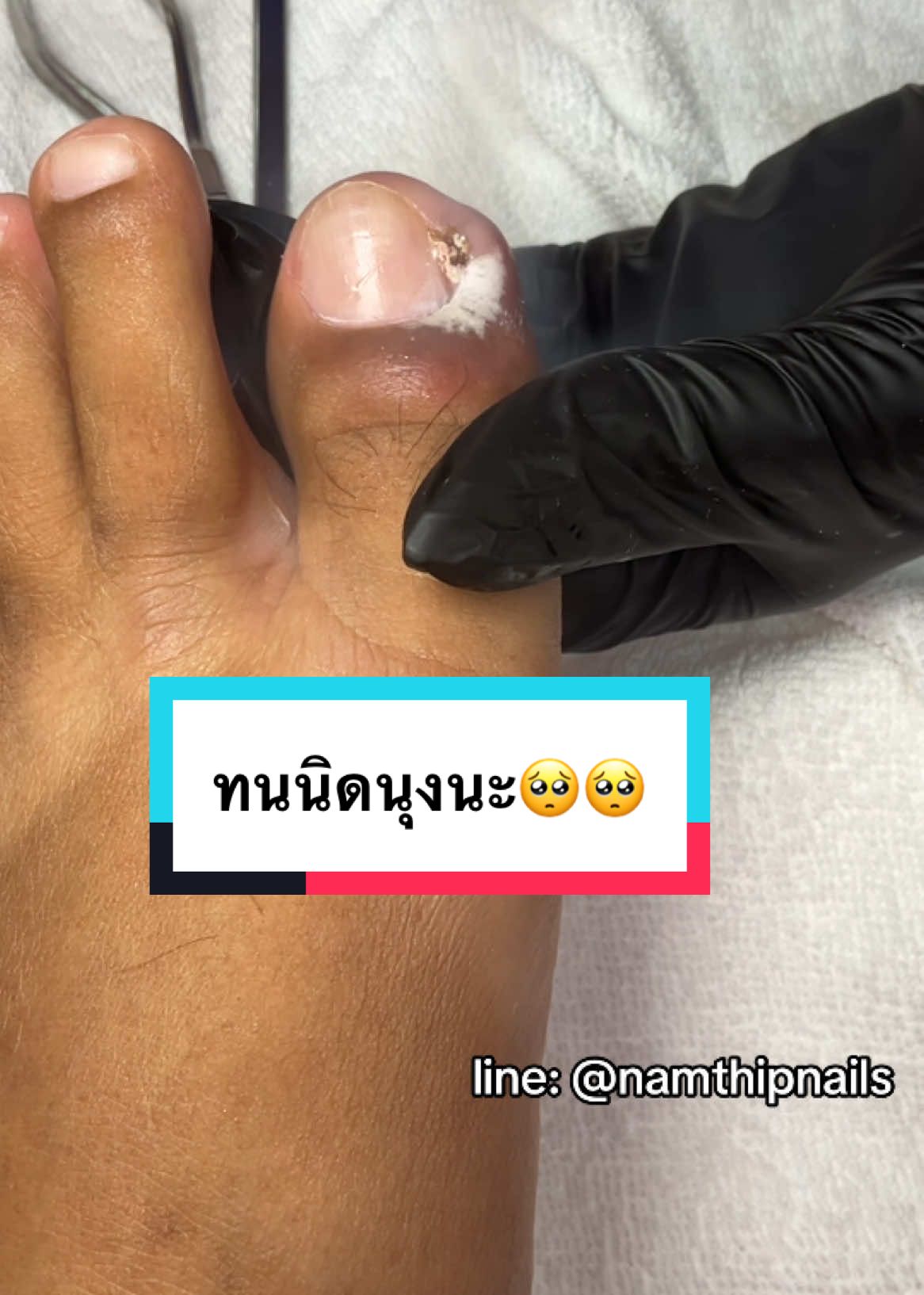 A post by @namthipnails5 on TikTok caption: 💓 #namthipnails #ตัดเล็บขบ #ตัดหนัง #ทำเล็บ #ร้านตัดเล็บขบ #ร้านตัดเล็บขบราม2 #ตัดเล็บ #เล็บขบ  #เล็บเชื้อรา Fb : namthipnails  Line : @namthipnails  นัมเบอร์วัน8 ตลาดม.ราม2  กทม  Map: namthipnails  https://goo.gl/maps/JmwpCKLfKwmhKGK96  ร้านเปิดทุกวัน เวลา12.00น-22.00น.