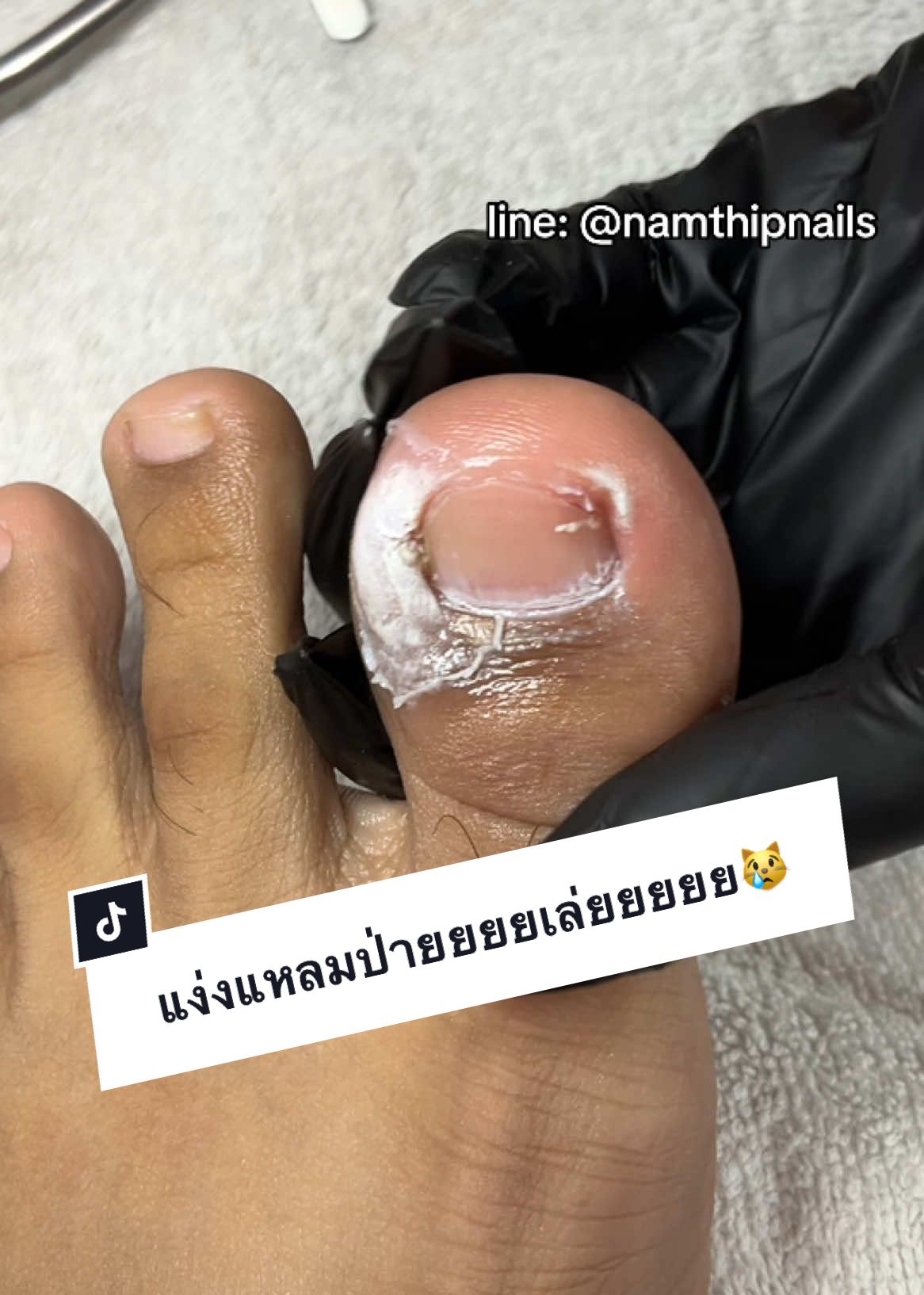 A post by @namthipnails5 on TikTok caption: 💓 #namthipnails #ตัดเล็บขบ #ตัดหนัง #ทำเล็บ #ร้านตัดเล็บขบ #ร้านตัดเล็บขบราม2 #ตัดเล็บ #เล็บขบ  #เล็บเชื้อรา Fb : namthipnails  Line : @namthipnails  นัมเบอร์วัน8 ตลาดม.ราม2  กทม  Map: namthipnails  https://goo.gl/maps/JmwpCKLfKwmhKGK96  ร้านเปิดทุกวัน เวลา12.00น-22.00น.
