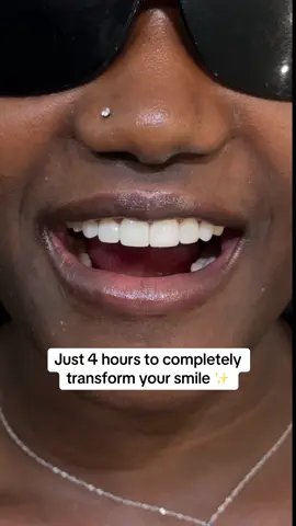 A post by @wondersmiledentalcenter on TikTok caption: Just 4 hours to completely transform your smile ✨ Ready to book? Call or text us at 561-668-5094 📲🦷 #veneersjourney #porcelainveneers #neworleansveneers #chicagoveneers #dentistry #veneerscolombia #bestdentalclinic #veneers #miamiveneers #hollywoodsmile #smiledesign #cosmeticdentist #cosmeticdentistry #dentaltourism #smiledentist #bestdentist #lifechanging #houstonveneers #exportingsmiles 