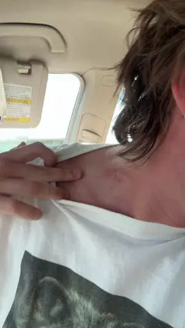 A post by @cartercartercartercarte on TikTok caption: possibly the dumbest excuse for a hickey ever