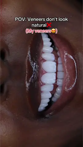 A post by @wondersmiledentalcenter on TikTok caption: Porcelain veneers, no pain – just perfection 💎 Now booking! 📲 561-668-5094 #Veneers #PorcelainVeneers #VeneerTransformation #SmileMakeover #HollywoodSmile #NewSmileWhoThis #BeforeAndAfter #GlowUp #DentalTok #SmileGoals