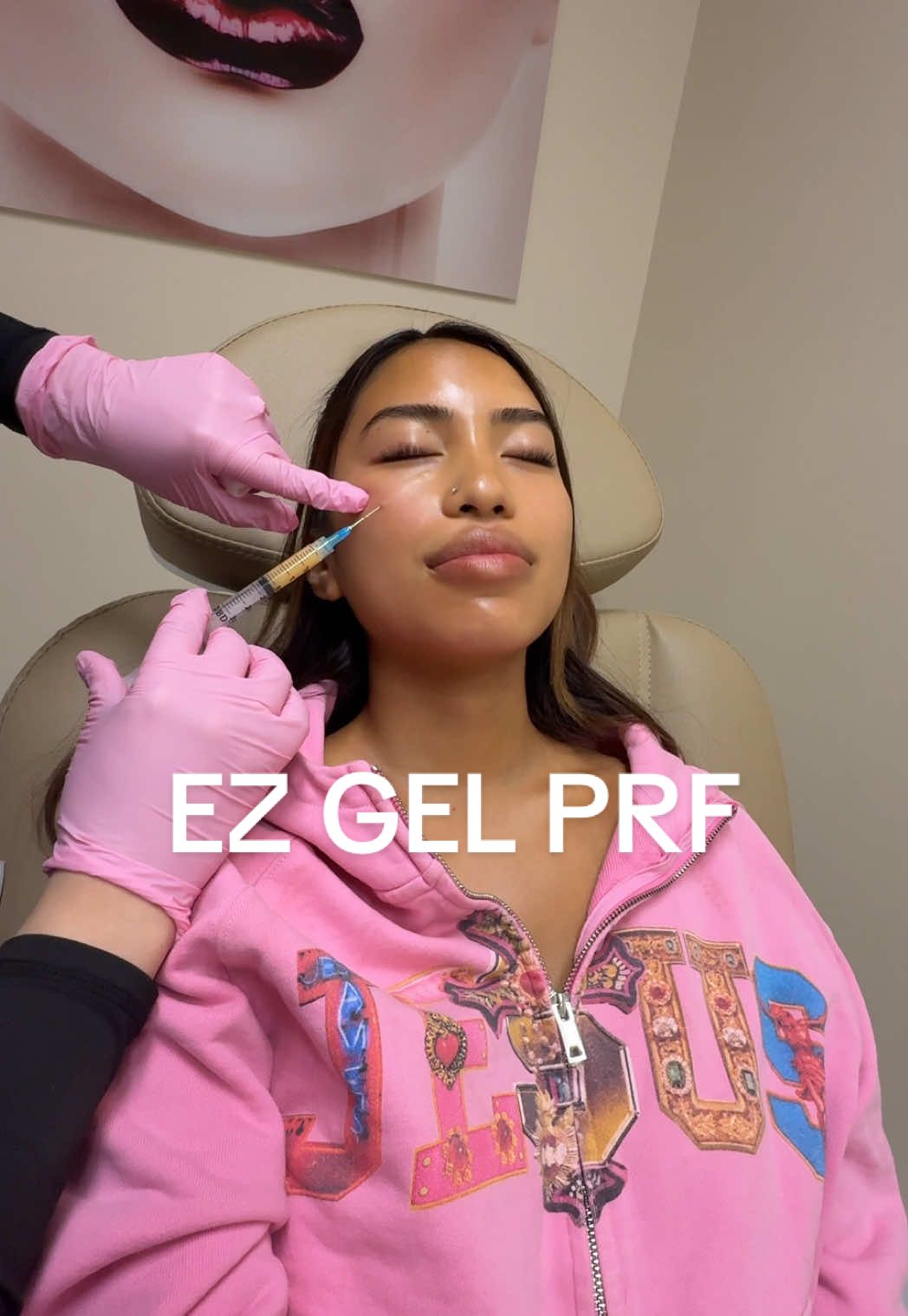 A post by @imabbysigua on TikTok caption: Treating my under eyes + smile lines with EZ GEL PRF-  so grateful we have more natural alternatives to filler ❤️ @totalbodyaestheticsla nurse: @annamtig on IG #glowyskin #skincareroutine #undereye 