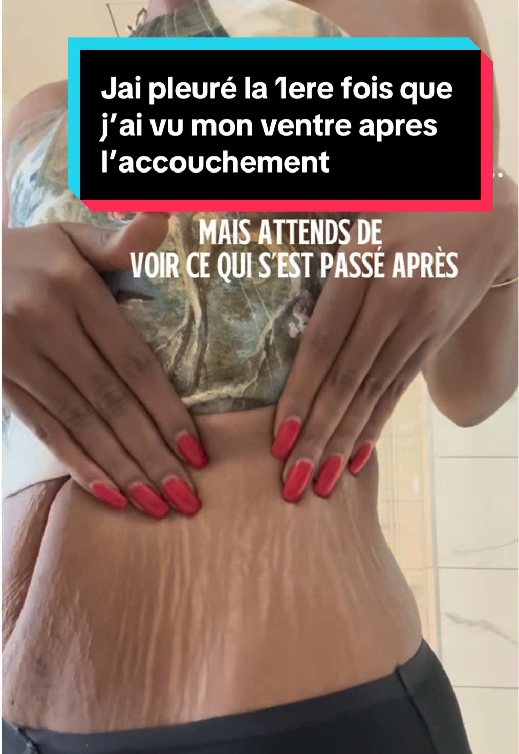 A post by @dialuskinfr on TikTok caption: SUMMER☀️Jusqu’à -30% sur tout le site 	•	-10% supplémentaires avec le code : SUMMER10 🎁 Ton moment pour dire adieu aux vergetures est arrivé. #stretchmark #stretchmarks #pourtoii #avantapres #enceinte #problem #vergetures 