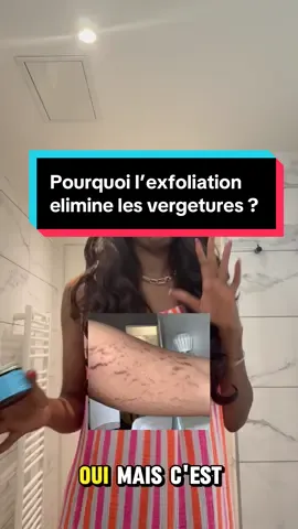 A post by @dialuskinfr on TikTok caption: Pourquoi l’exfoliation elimine les vergetures ?  #stretchmark #stretchmarks #verite #avantapres #solution #pourtoii #foryour #conseil #vergetures 