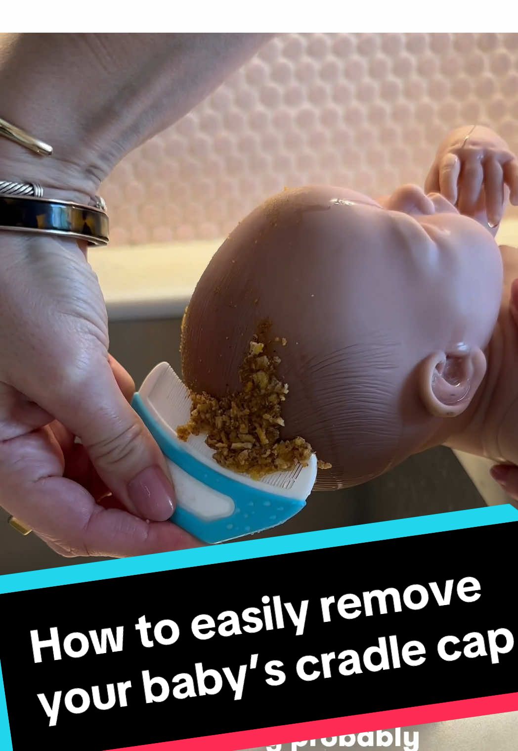A post by @fridababy on TikTok caption: Here’s the deal, parents: 7 in 10 babies get cradle cap. So chances are you’ll probably deal with it at some point. If it’s mild it might look like a little flaking on your infant’s scalp but it can get pretty gnarly, with thick, yellow scales on their head. You’ll be tempted to pick at it, but *please* resist. Picking at it can lead to scabbing or even hair loss. Instead use this gentle routine to lather, loosen and lift flakes away from their scalp. 1️⃣ Grab a Cradle Cap Scalp Mask or cradle-cap friendly shampoo 2️⃣ Lather with the soft foam sponge to soften flakes. 3️⃣ Use the super gentle silicone bristle brush to loosen flakes away from the scalp. 4️⃣ Then come through with the comb to gently lift everything away. This is obviously the most satisfying thing ever. . . #cradlecap #babyessentials #babymusthaves #primeday #primedaydeals #newborntips #babyregistrymusthaves 