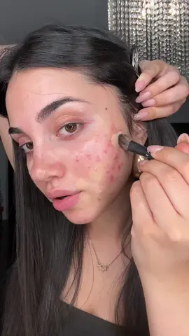 A post by @belikeanna on TikTok caption: ciao amiche in tante mi state chiedendo la mia makeup routine da quando ho l’acne. Capisco quanto sia difficile trovare prodotti con buona coprenza ma acne free che quindi non ci vadano a stressare ancora di più la pelle. Questo video l’ho registrato qualche settimana fa, fatemi sapere se volete la routine aggiornata e se avete altre domande su questi prodotti. Colgo l’occasione per continuare a ringraziarvi per tutto l’affetto che mi state mandando, vi voglio tanto bene 🍓 #acnefree #makeup #tutorialmakeup 