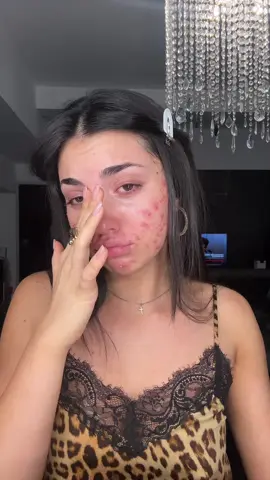 A post by @belikeanna on TikTok caption: che dire amici, sono una persona che odia farsi vedere debole, non piango mai davanti a nessuno, che sia un’amica, un parente, i miei stessi genitori.. non riesco a mostrarmi vulnerabile, a chiedere aiuto, a esporre un mio problema.. eppure eccomi qua a mostrarmi totalmente senza filtri davanti a tutto il web, il motivo? semplice.. continuavo a ricevere messaggi di complimenti, di persone che stanno affrontando il mio stesso male “ che avrebbero voluto un minimo della mia forza” ebbene, anche su questo vi distruggo un mito, anch’io come voi, ho momenti di forza , come quelli mostrati fin’ora, e momenti come questo.. anche questa è normalità  condivido questo momento per farvi comprendere che anche in questo, non siete sbagliati e nemmeno deboli, siete semplicemente UMANI🤍🍓 e va benissimo cosi! colgo l’occasione per ringraziarvi ancora per tutti i messaggi che mi mandate, scusate se non riesco a rispondere a tutti, vorrei con tutto il cuore ma siete tantissimi e di questo sono veramente grata, vi chiedo solo un piacere, continuate a condividere queste parole, non solo a me in privato ma soprattutto agli altri e qui sui social, un piccolo messaggio può cambiare totalmente la giornata di una persona ❤️ #acne 