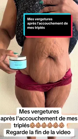 A post by @dialuskinfr on TikTok caption: Mes vergetures après l'accouchement de mes triplés Regarde jusqu'à la fin de la vidéo #stretchmark #stretchmarks #pourtoii #avantapres #enceinte #problem #vergetures 