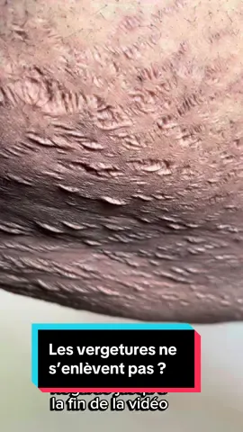 A post by @dialuskinfr on TikTok caption: Les vergetures ne  s’enlèvent pas ?  #stretchmark #stretchmarks #pourtoii #avis #avantapres #problem #vergetures 