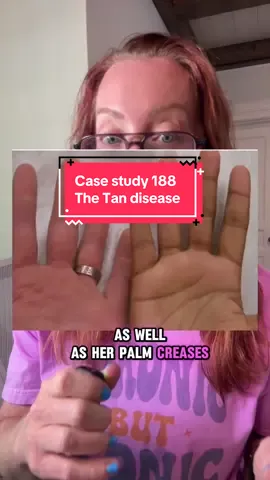 A post by @ladyspinedoc on TikTok caption: Case 188: The Tan Disease She’s 35, healthy, and active, or at least she used to be. Over the past few months, her friends started complimenting her “glow” and asking if she’d been on vacation. But what they didn’t know was that behind the deepening tan was crushing fatigue, dizzy spells, and unexplained weight loss. She’s not tanning. Her body is sending a warning. Let’s dive into the clues. #Casestudy188 #MedicalMystery #TheTanDisease #ladyspinedoc #SundayCaseStudy 