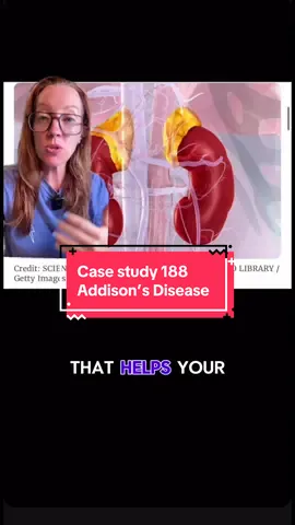 A post by @ladyspinedoc on TikTok caption: Replying to @user624438971705 Case Study 188: Addison’s Disease This rare endocrine disorder occurs when the adrenal glands don’t produce enough cortisol and aldosterone. Patients often present with fatigue, weight loss, low blood pressure, salt cravings, and even skin hyperpigmentation, especially in the creases of the hands or inside the mouth. It’s often misdiagnosed until a crisis hits. Diagnosis involves checking ACTH and cortisol levels, followed by an ACTH stimulation test. Treatment includes lifelong hormone replacement with hydrocortisone and fludrocortisone. 🧠 Always think of Addison’s in patients with unexplained fatigue and low sodium: early recognition can be life-saving. #AdrenalInsufficiency #MedicalEducation #DoctorLife #CaseStudy188  #addisonsdisease #LadySpineDoc #SundayCaseStudy